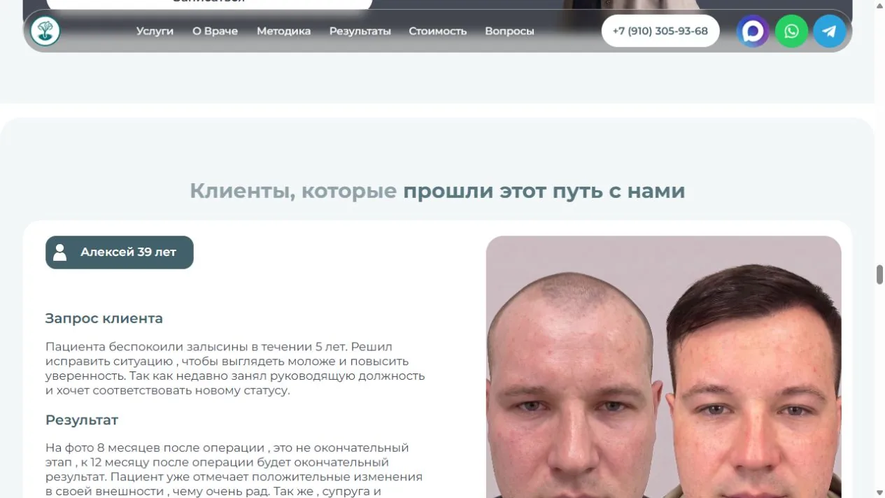 Before-and-after hair transplant patient cases